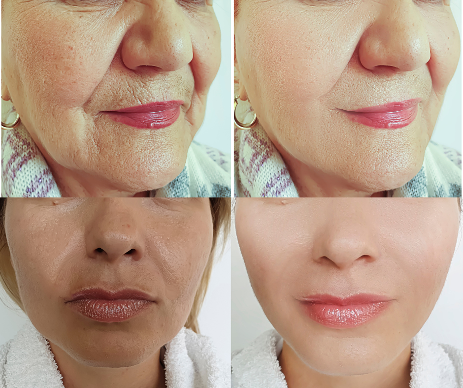 Myvella LiftSculpt™ Microcurrent Face Lift